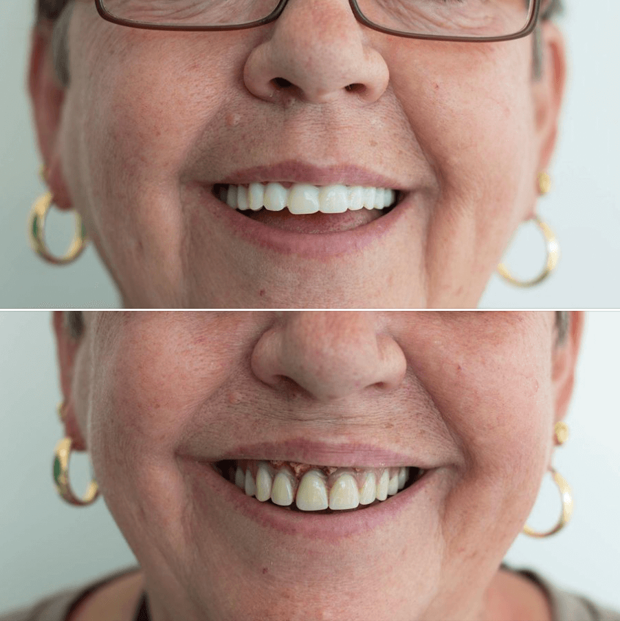 Before and after dentures from Denture Care Shop.