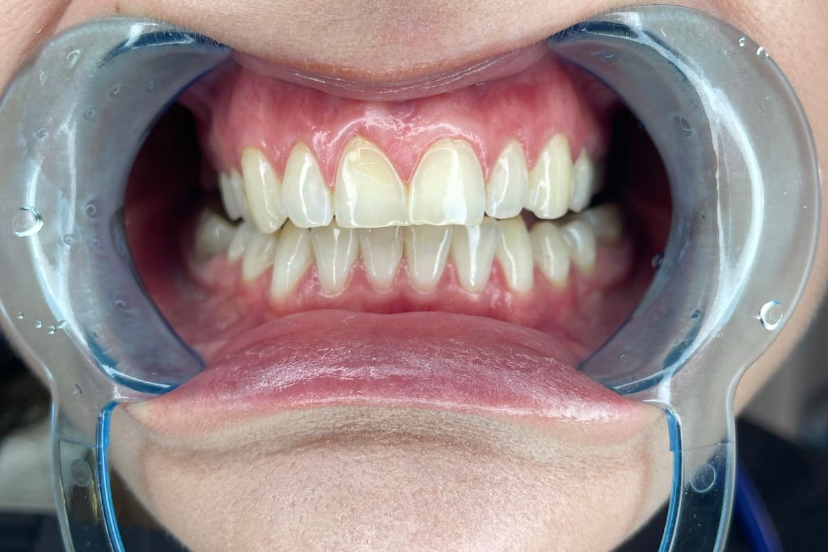 Find out how long orthodontic treatment can take, from braces to clear aligners, and what factors may speed up or extend the process.