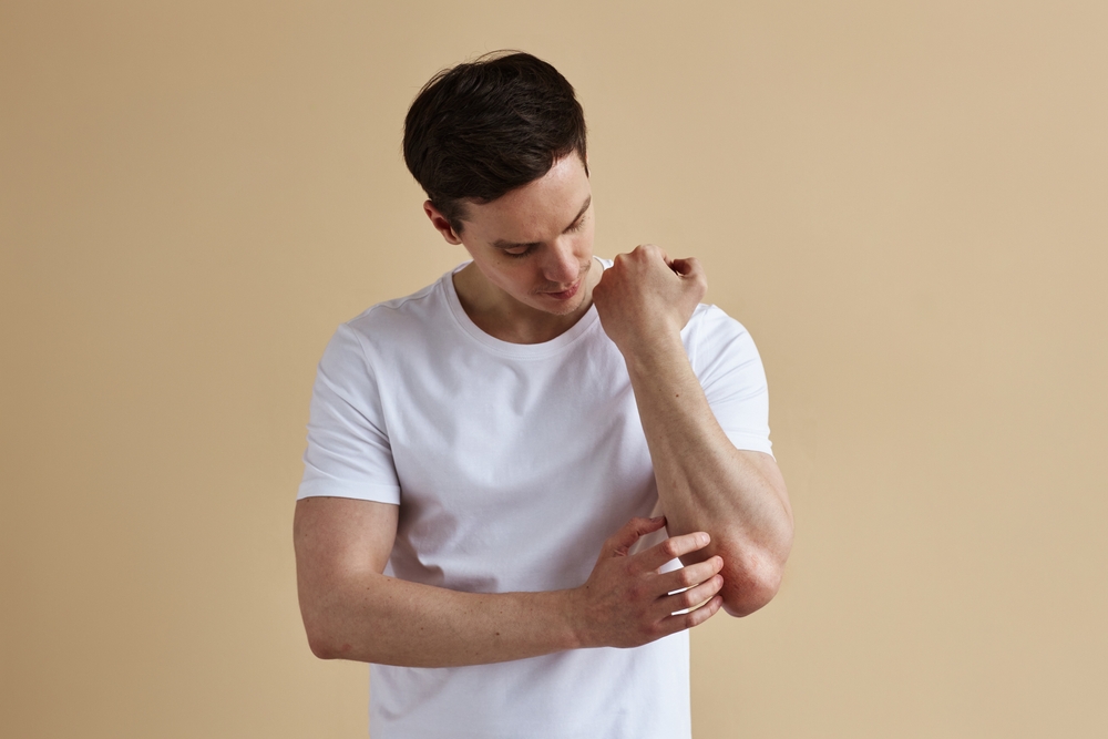 psoriasis