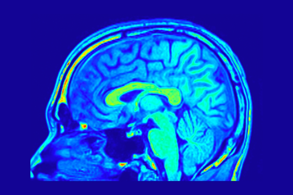 Color-enhanced sagittal MRI scan showing a side view of the human brain
